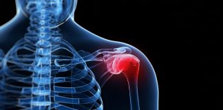 De SNN Praktijkrichtlijn Frozen Shoulder