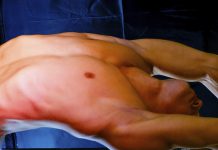 Slechter herstel als je minder spiermassa hebt gespierd