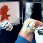 injectable cartilage plasters
